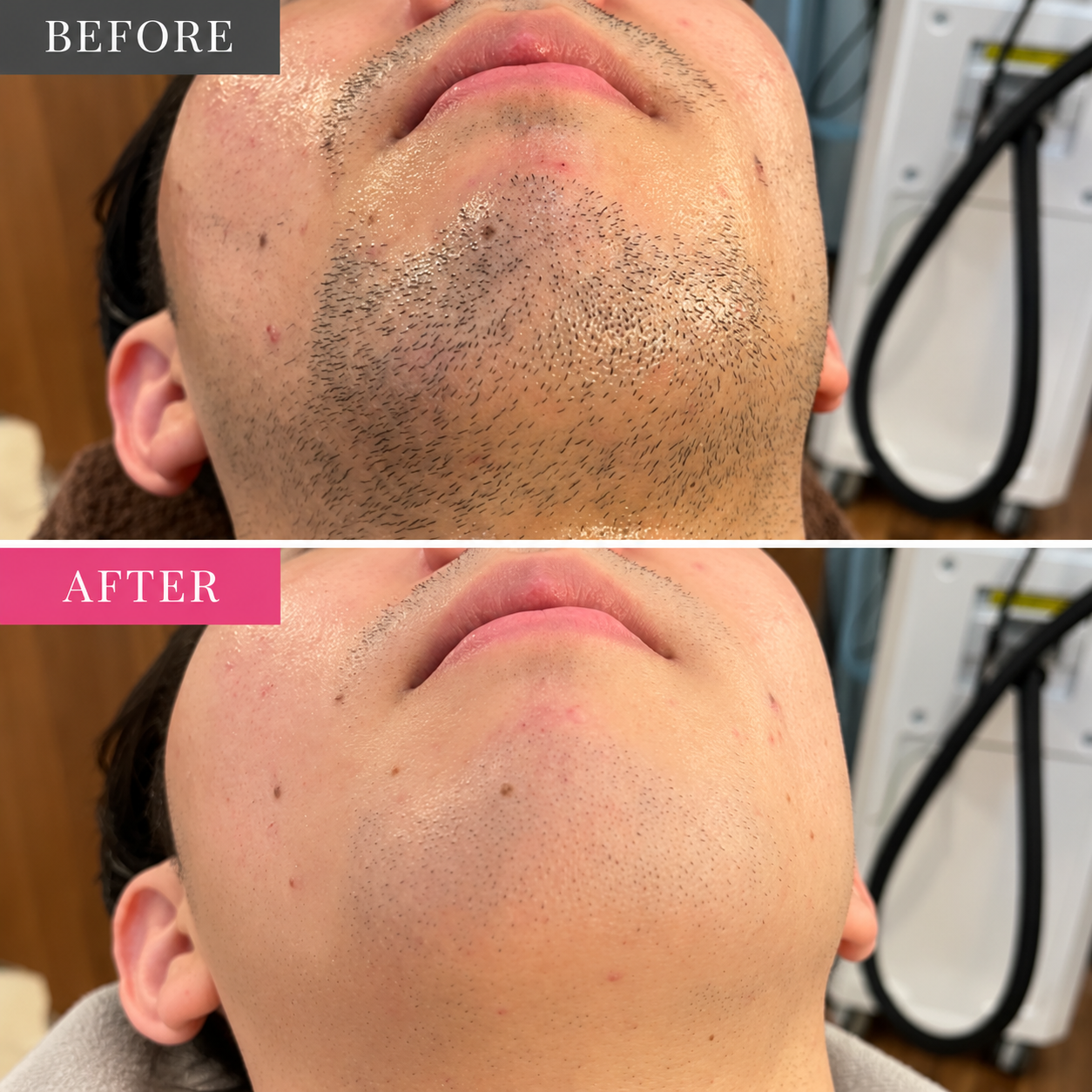 ひげ脱毛前後のビフォーアフター写真（上がBEFORE、下がAFTER）