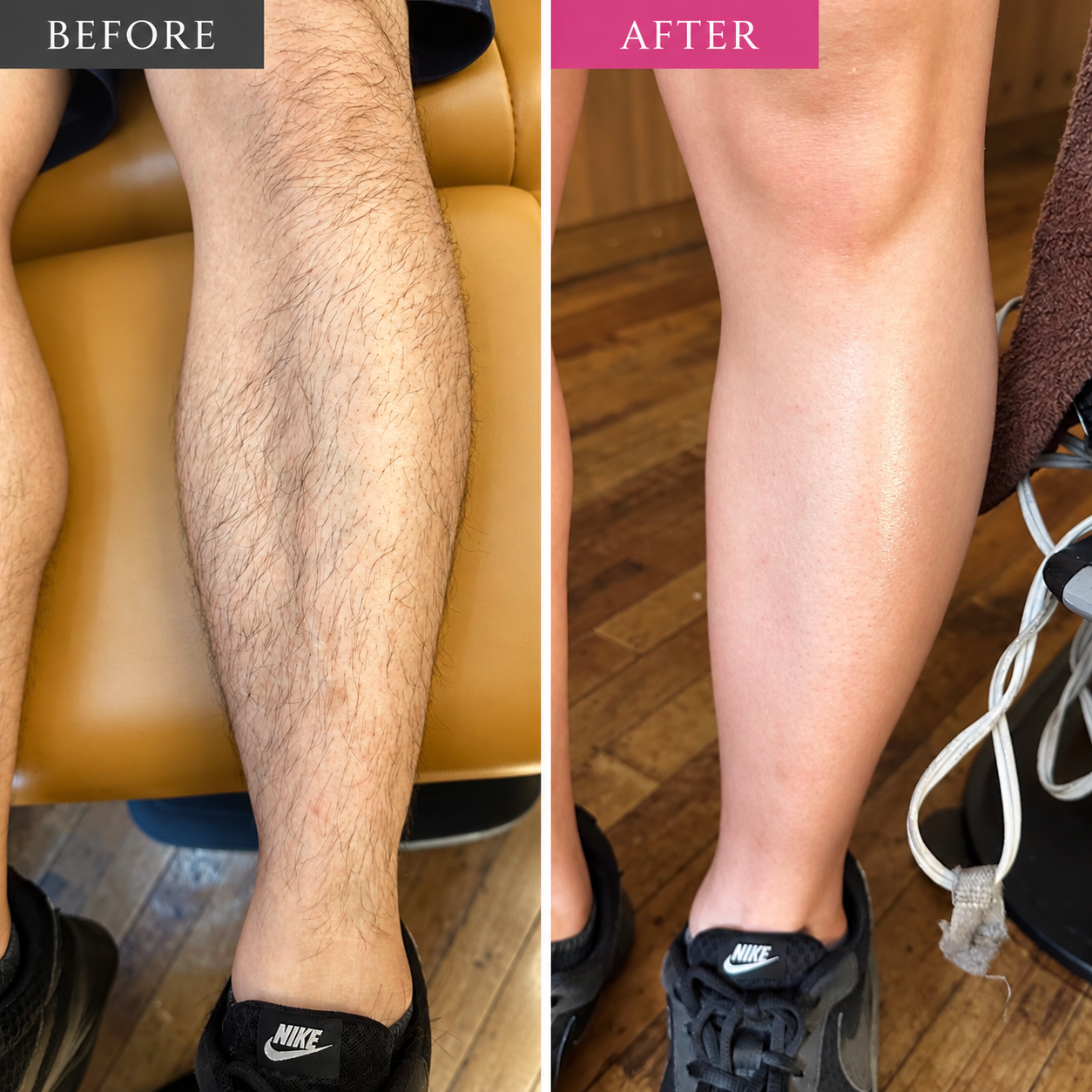 脚のビフォーアフター写真（左がBEFORE、右がAFTER）