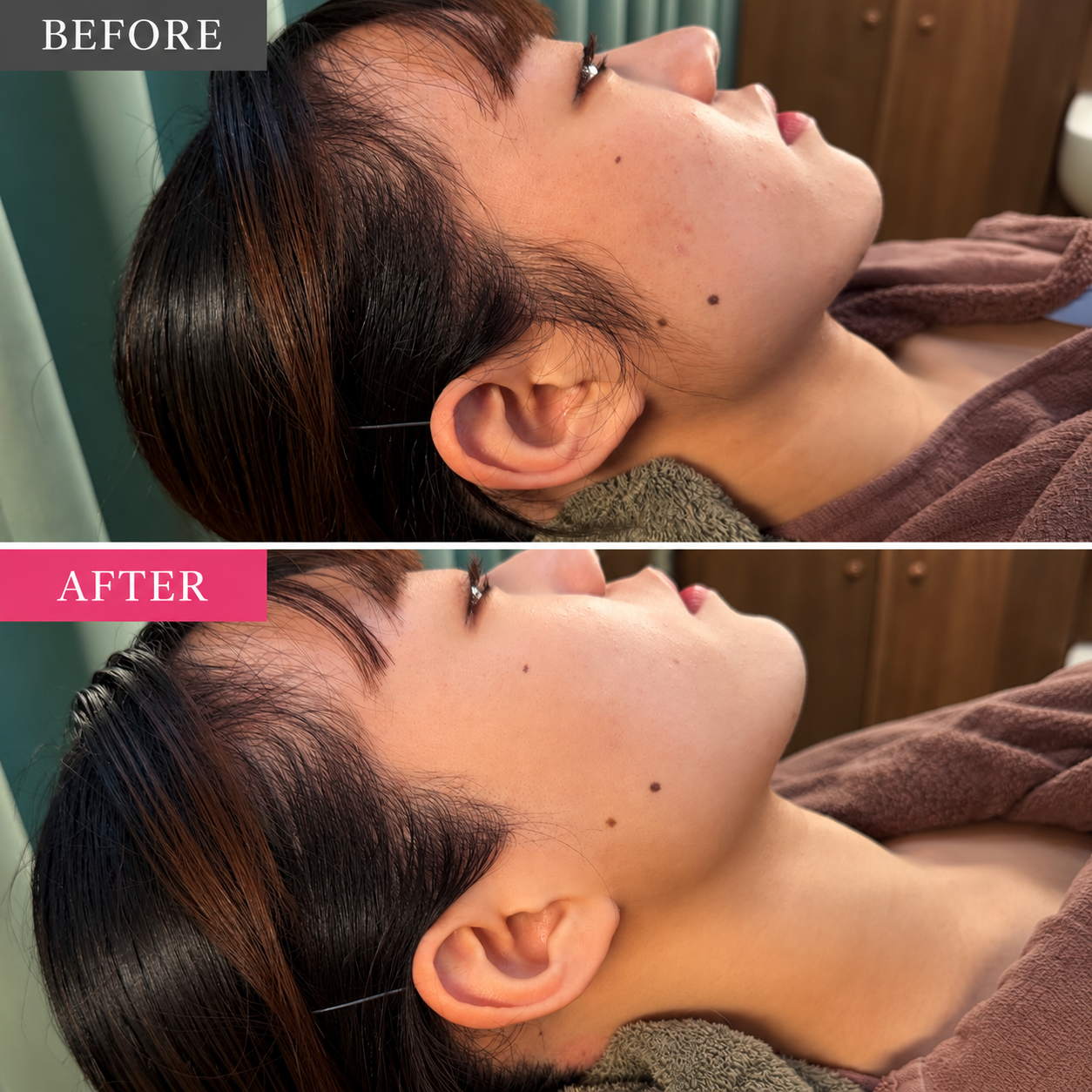 あご・ヒゲまわりのシェービング前後のビフォーアフター写真（上がBEFORE、下がAFTER）